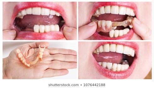 Metal Partial Dentures Salt Lake City UT 84148